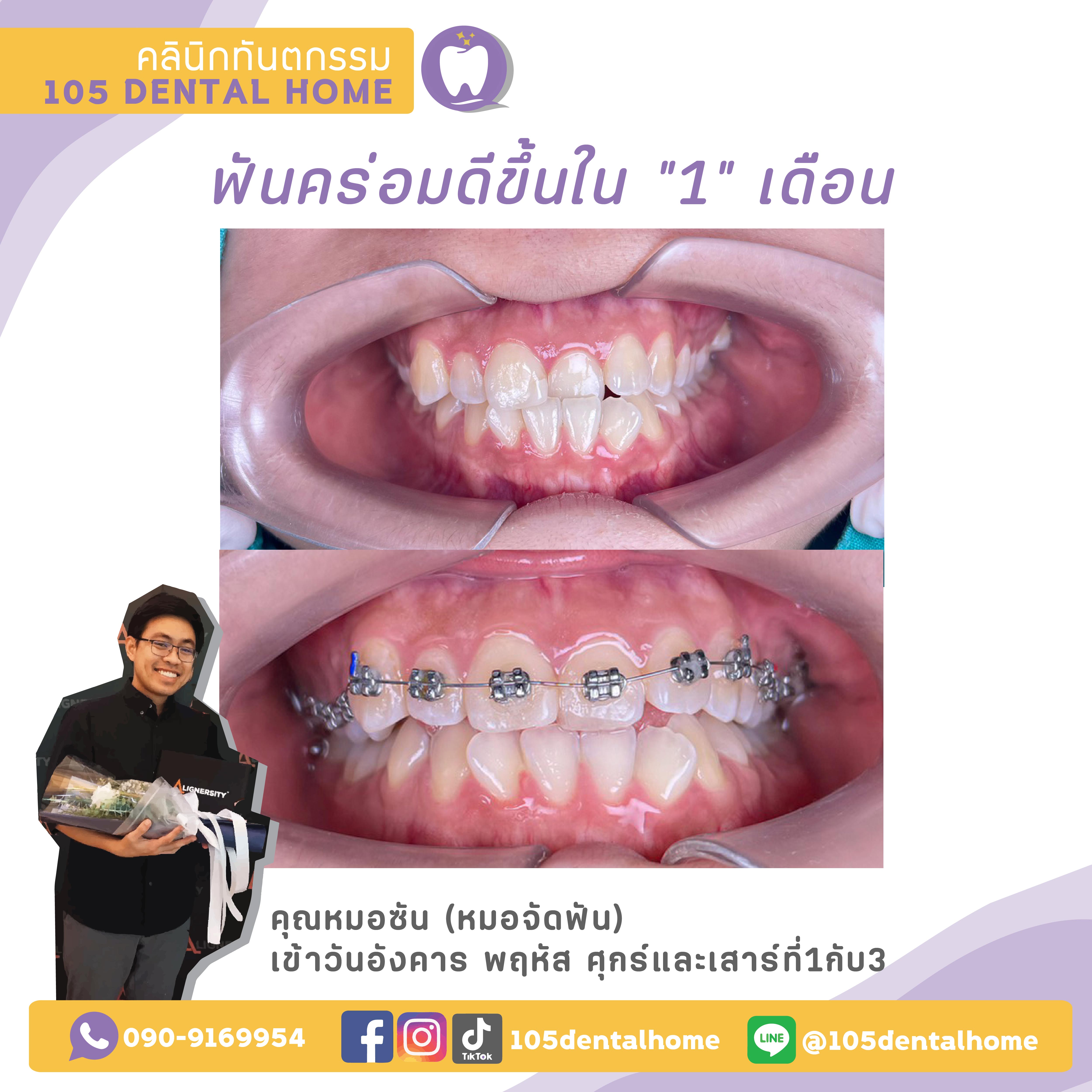 ทันตกรรมจัดฟัน