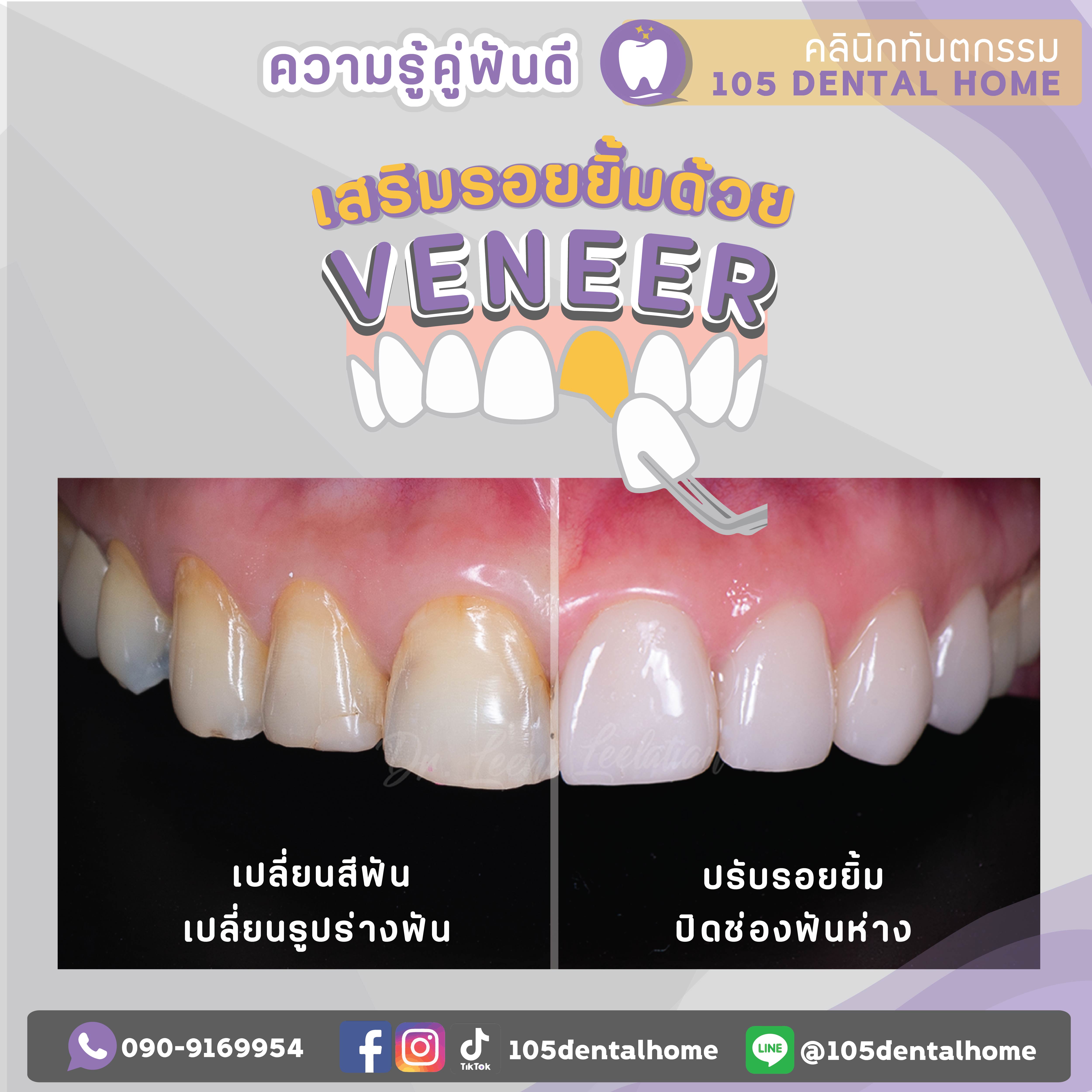 วีเนียร์