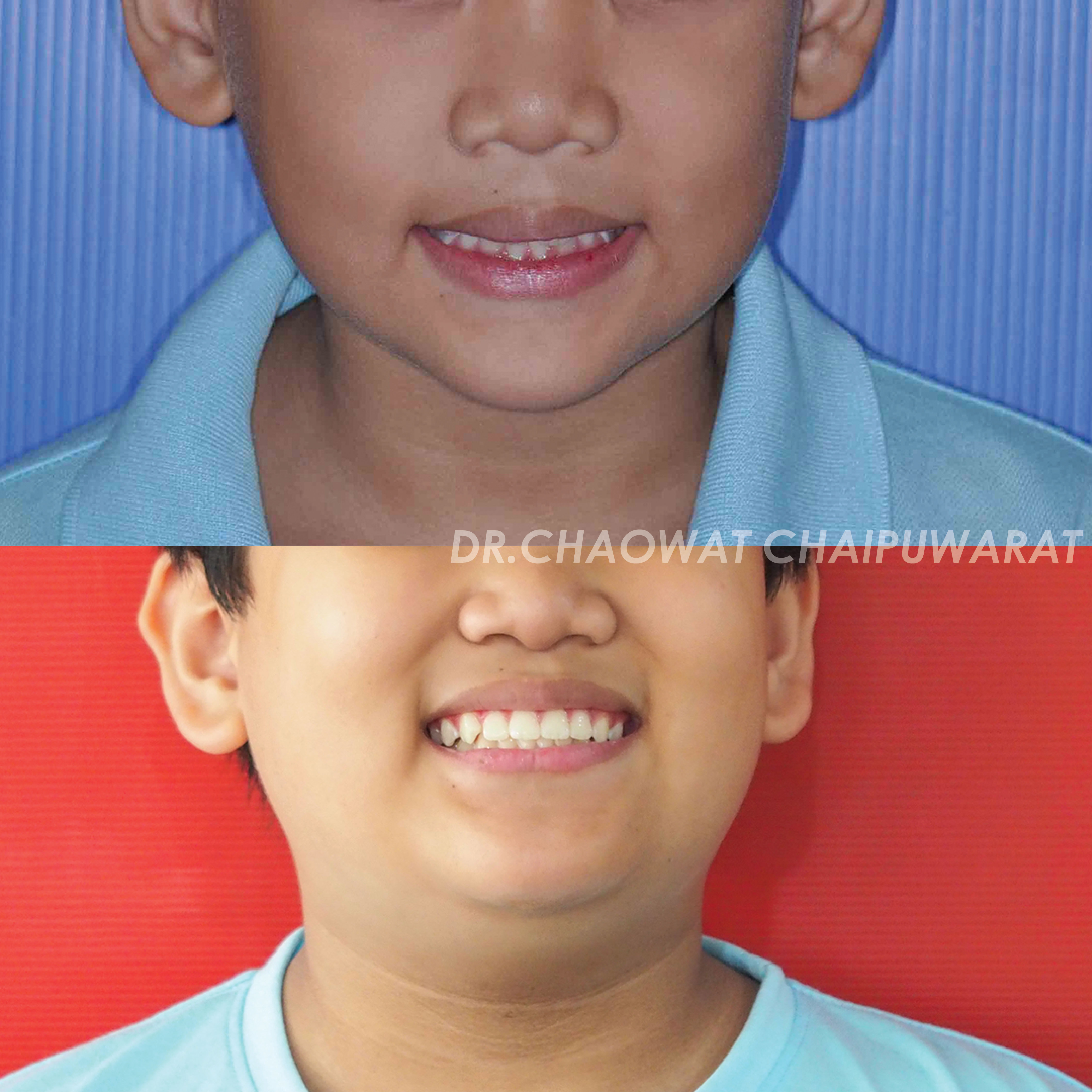 จัดฟันโลหะ