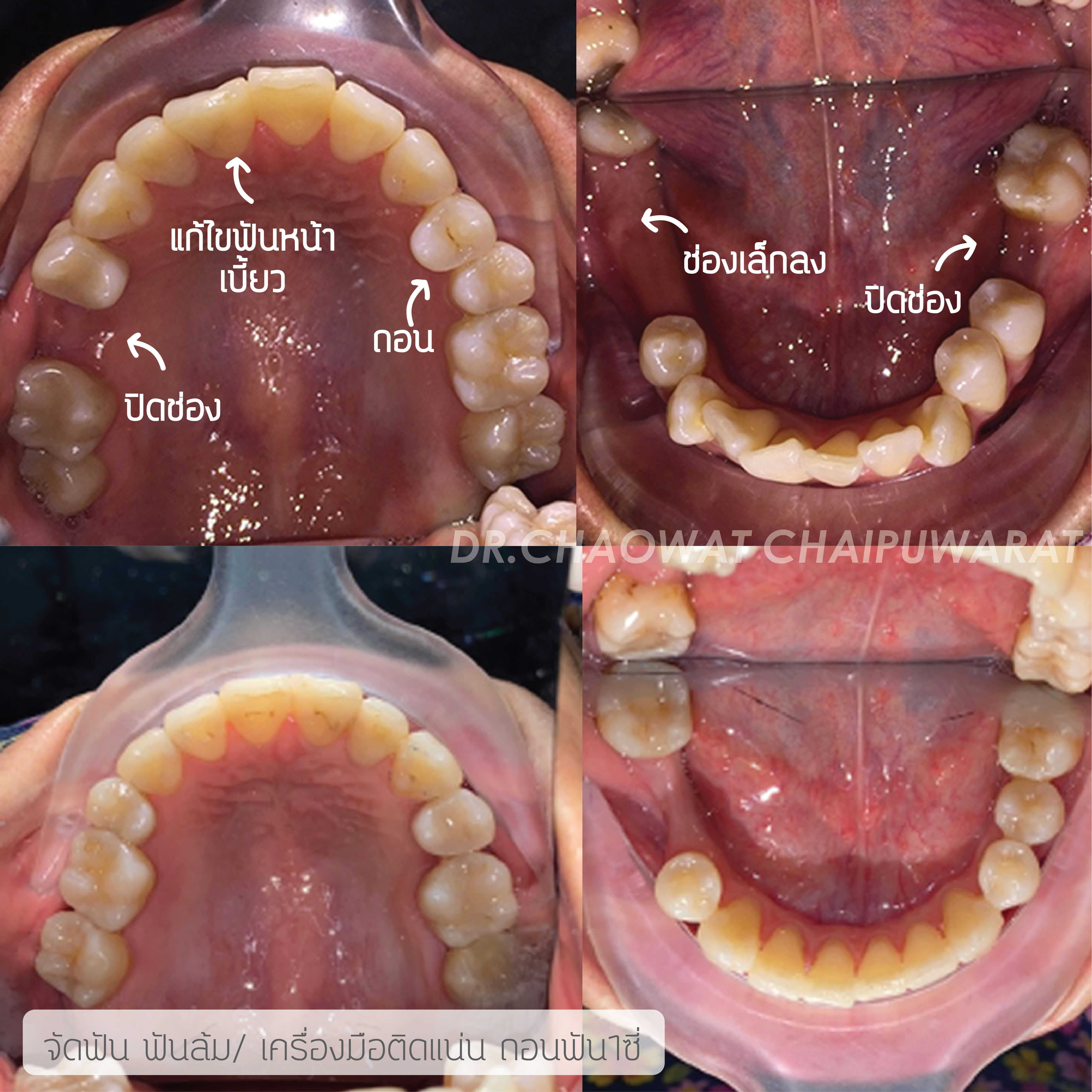 จัดฟันโลหะ
