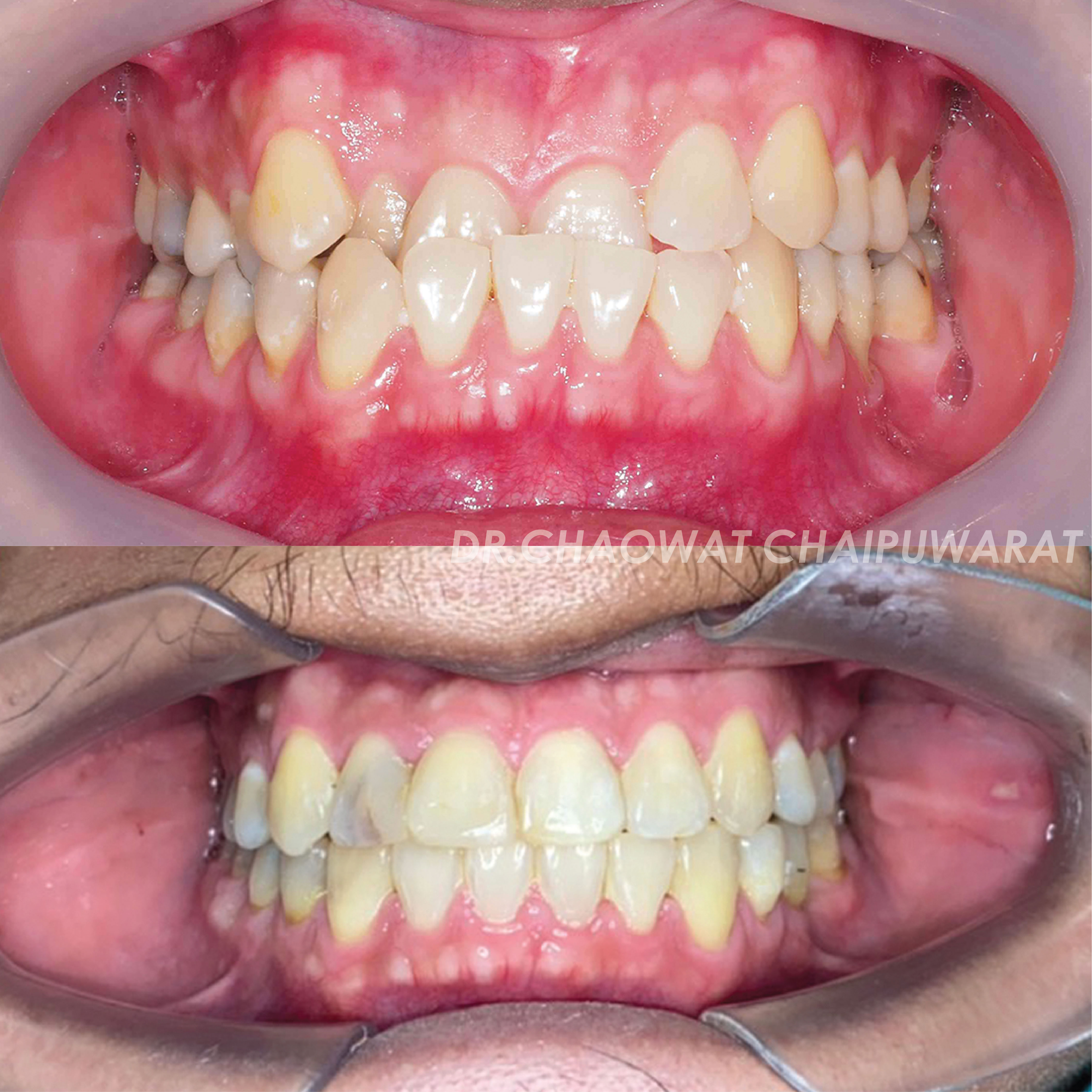 จัดฟันโลหะ