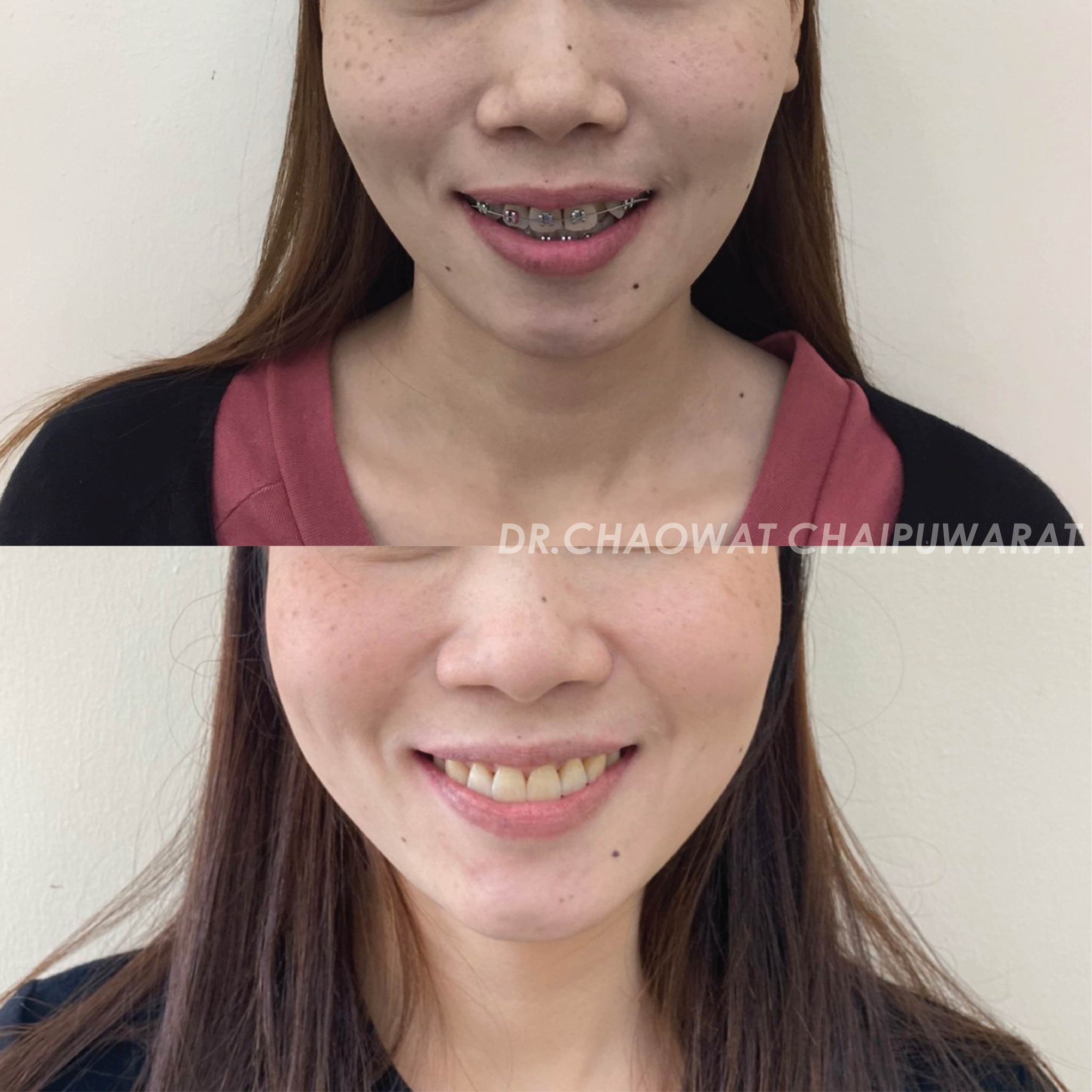 จัดฟันโลหะ