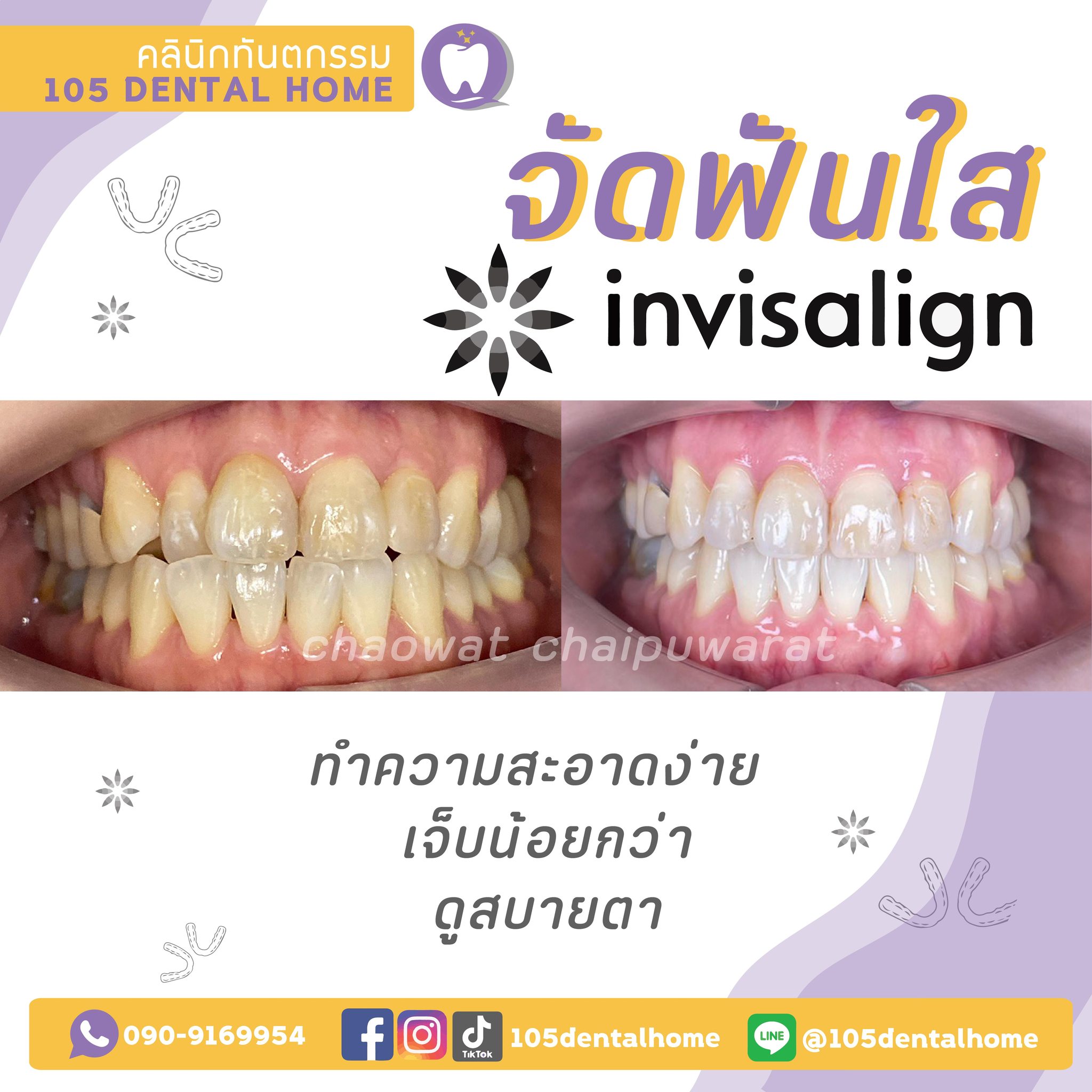 จัดฟันใส