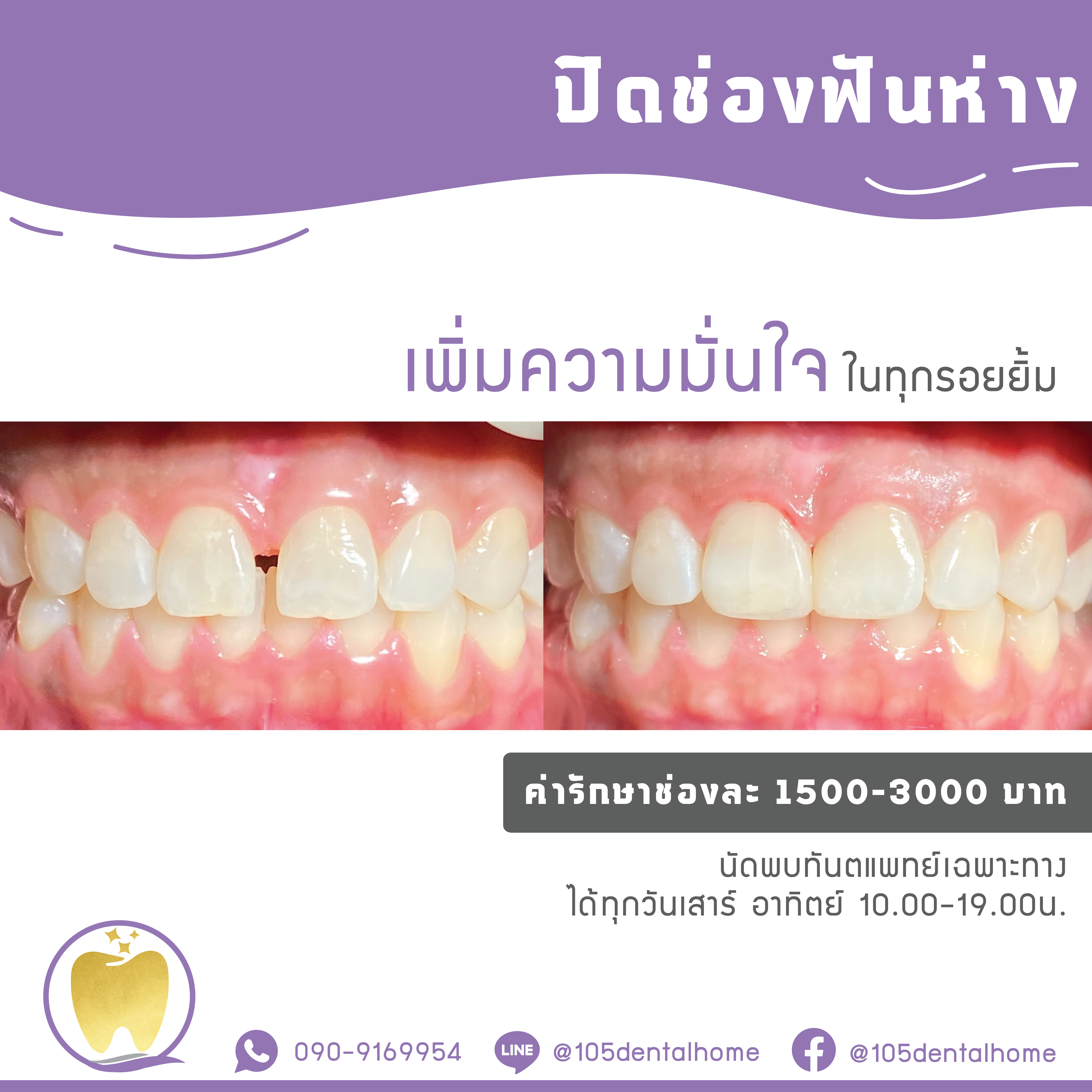 อุดปิดช่องฟันห่าง