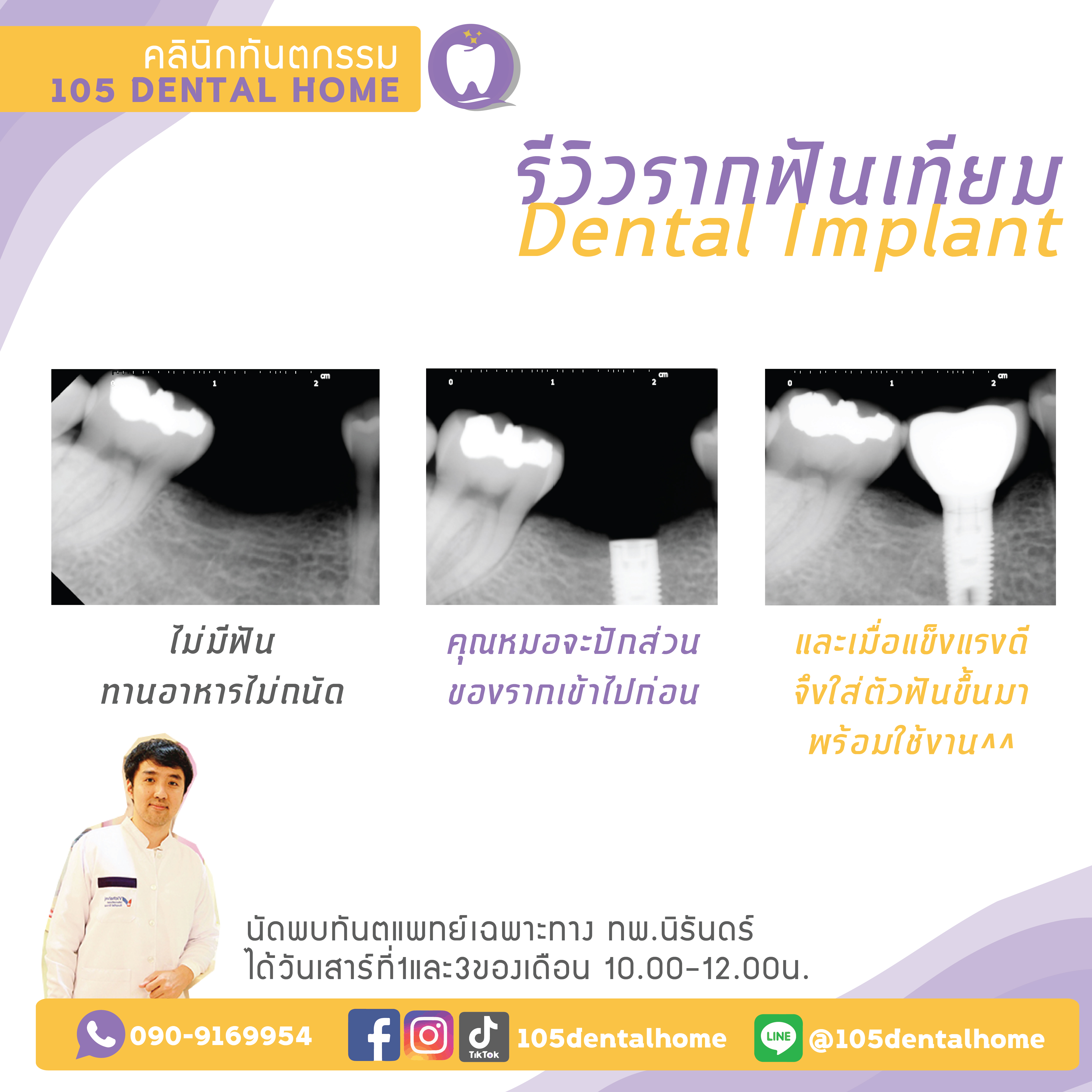 รากฟันเทียม