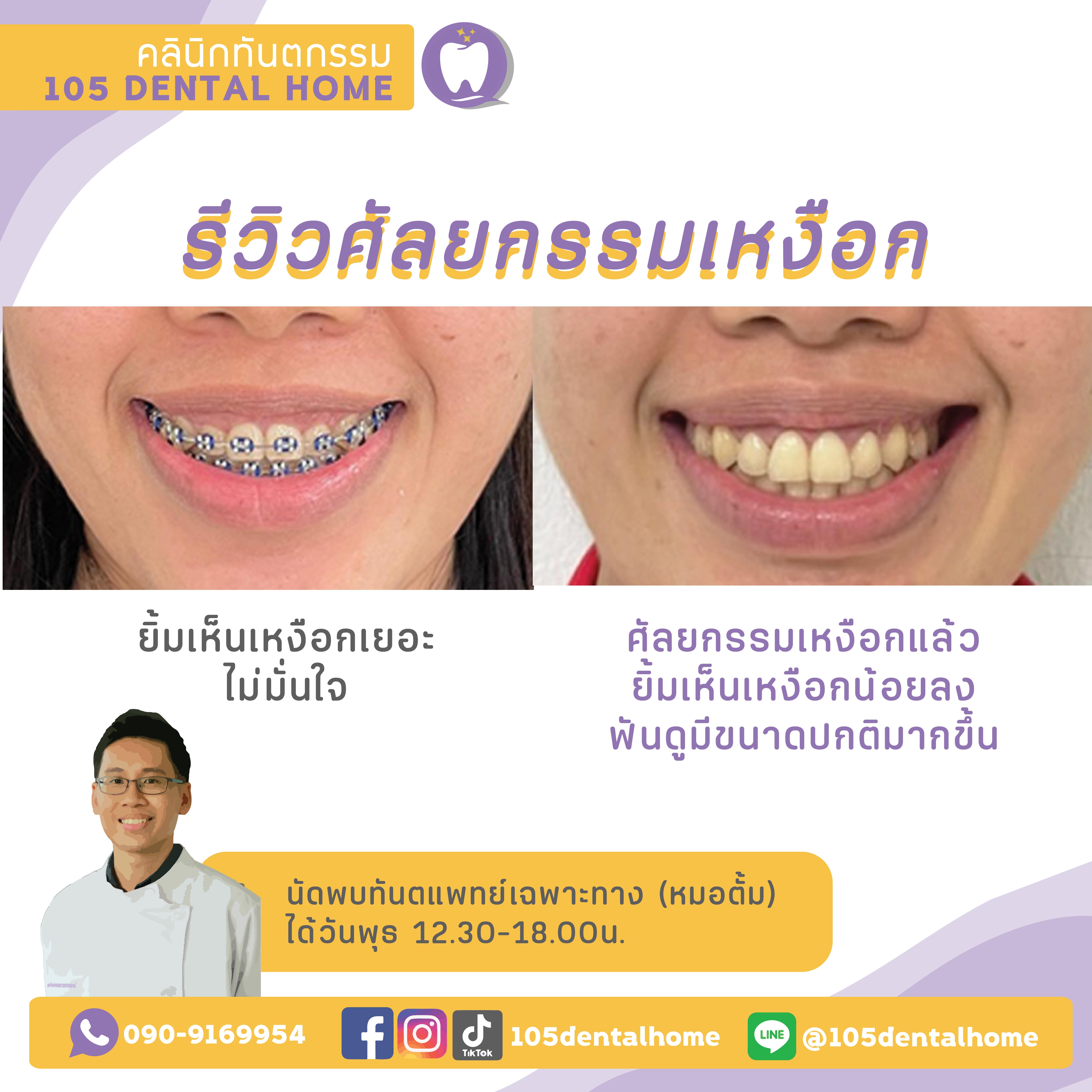 ศัลยกรรมเหงือก