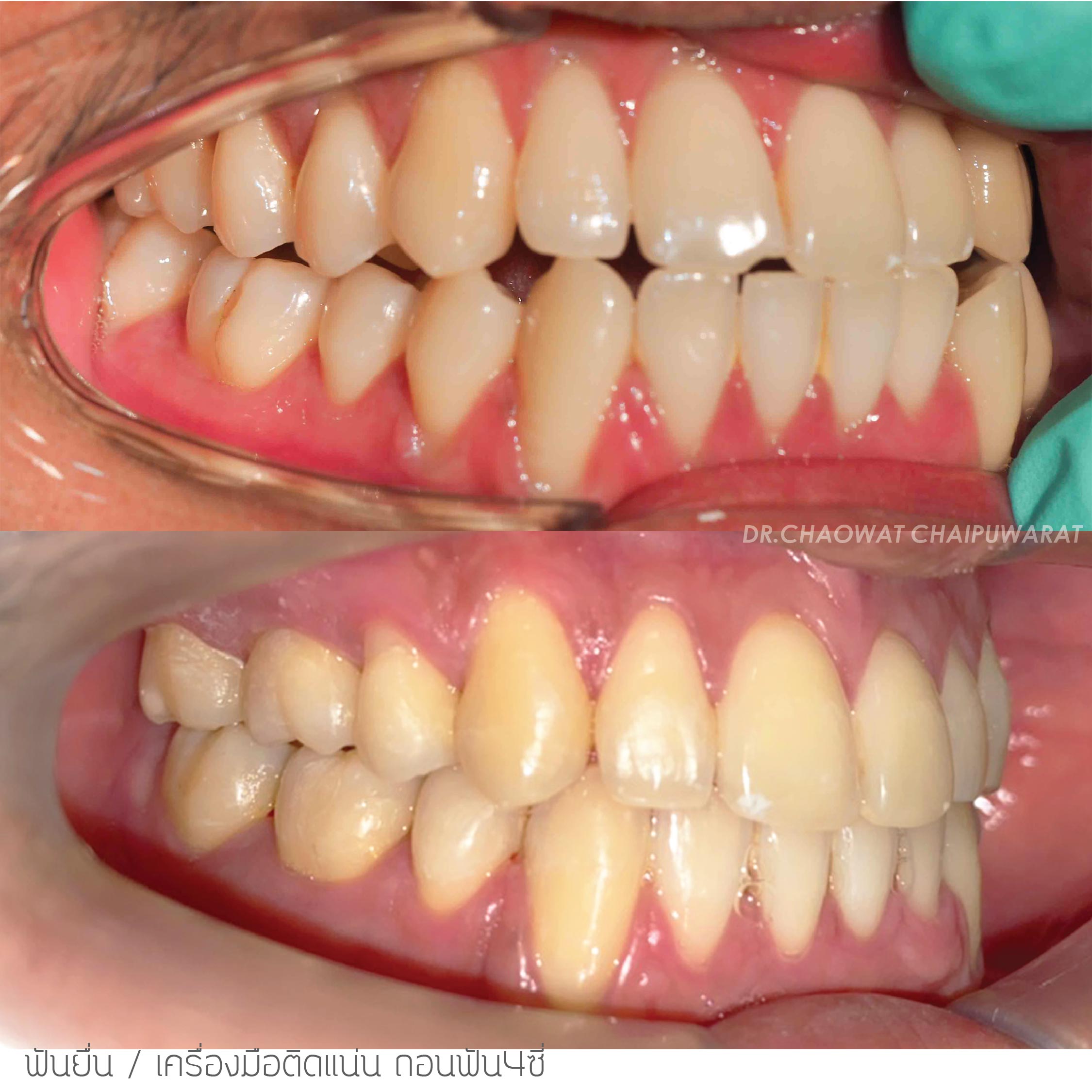 จัดฟันโลหะ