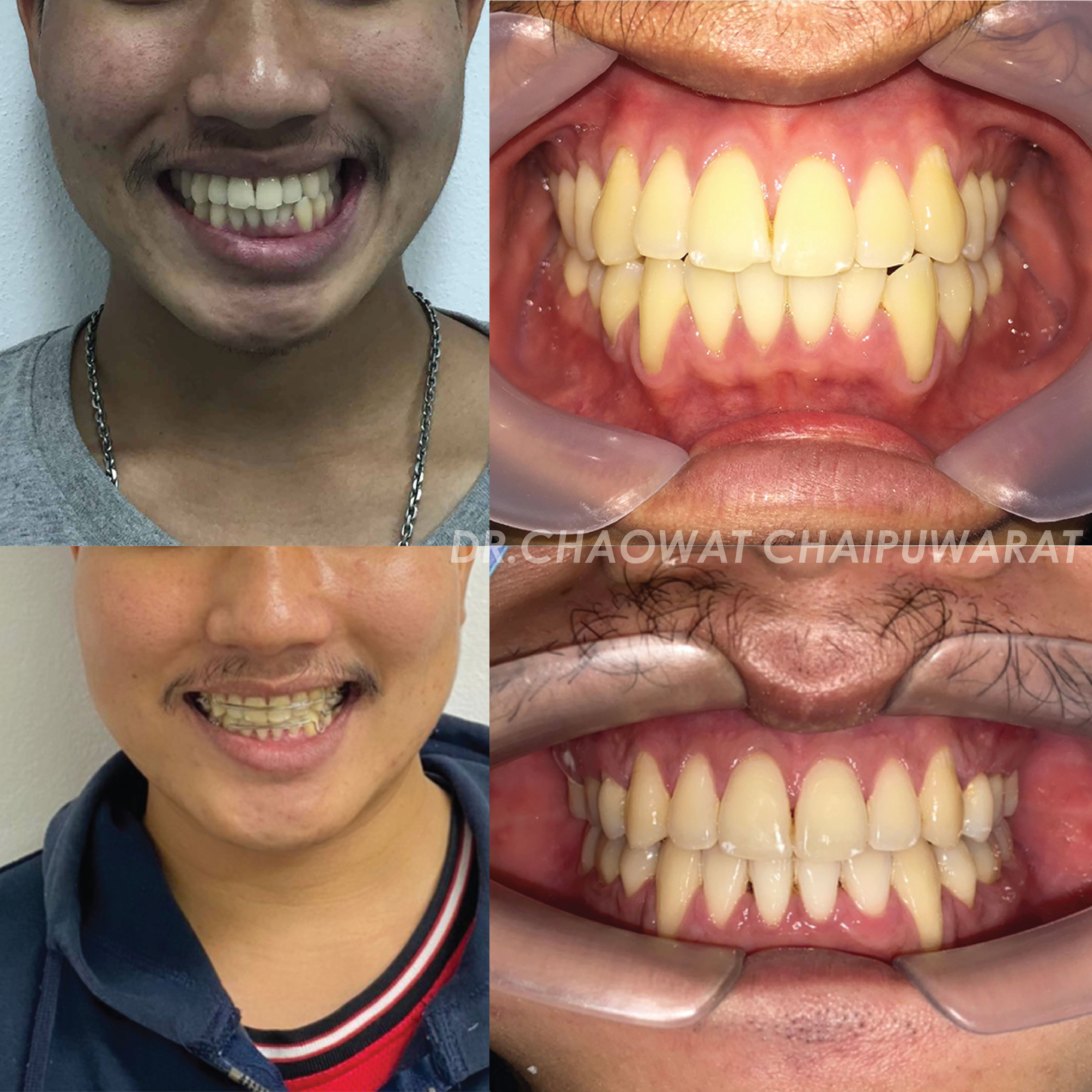 จัดฟันโลหะ