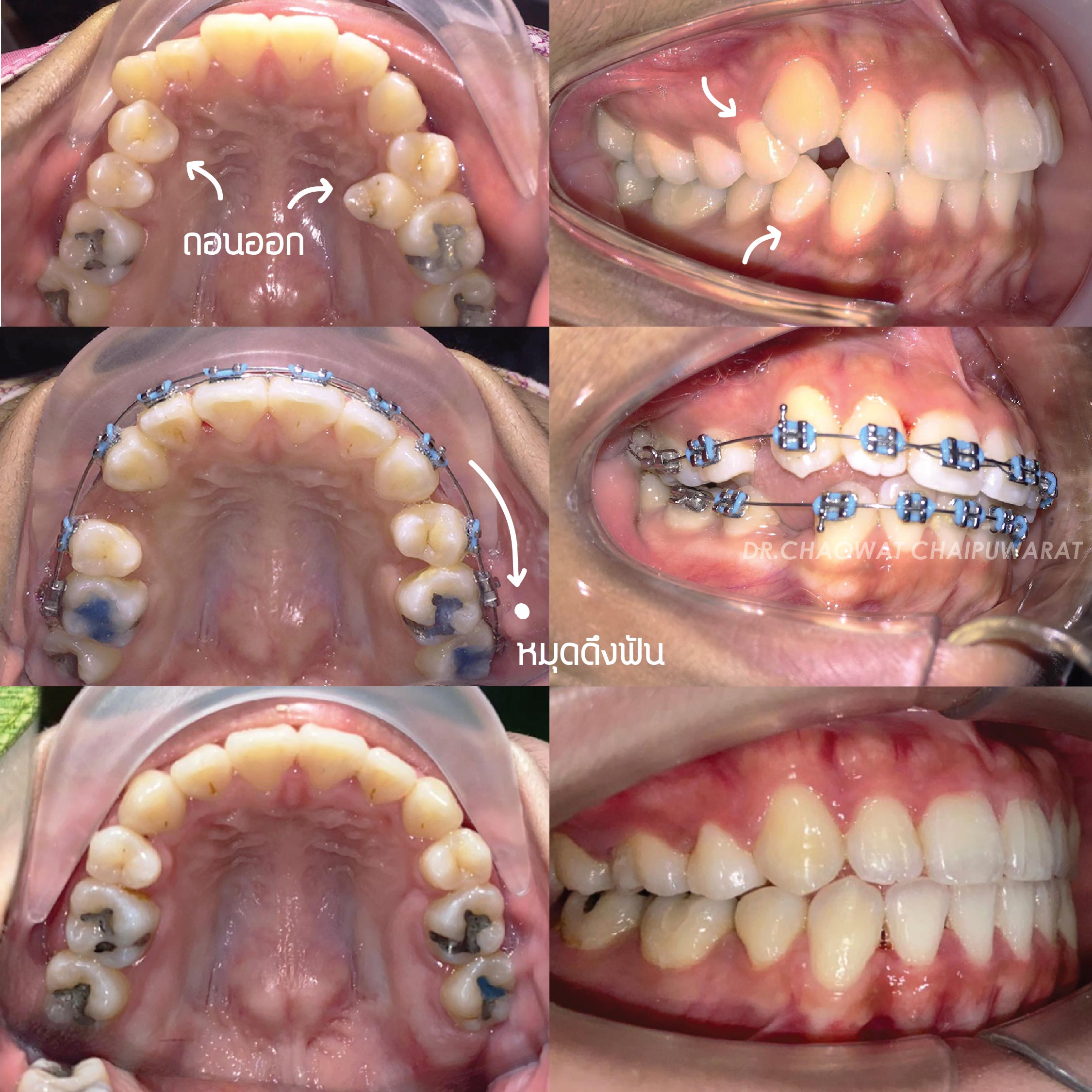 จัดฟันโลหะ