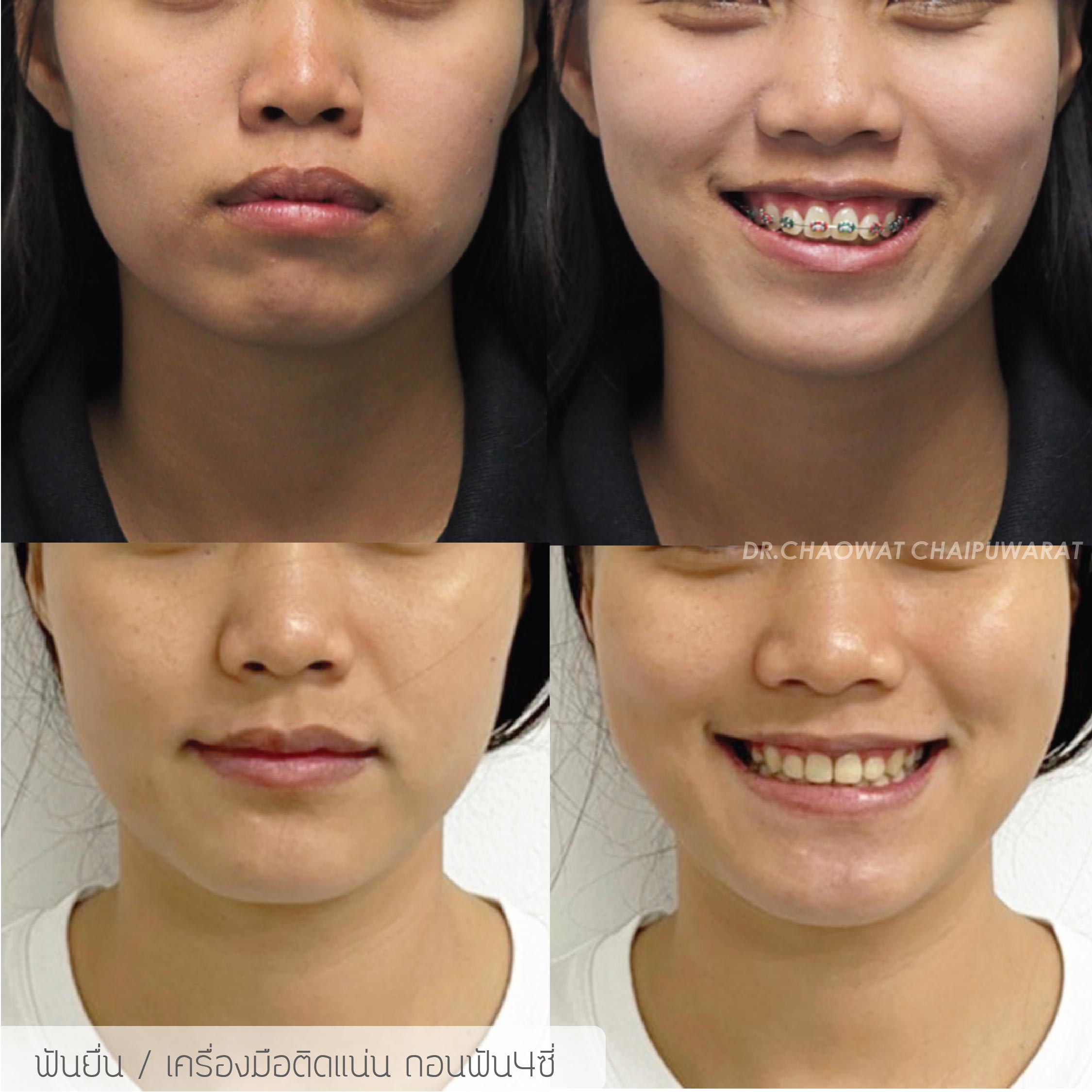 จัดฟันโลหะ