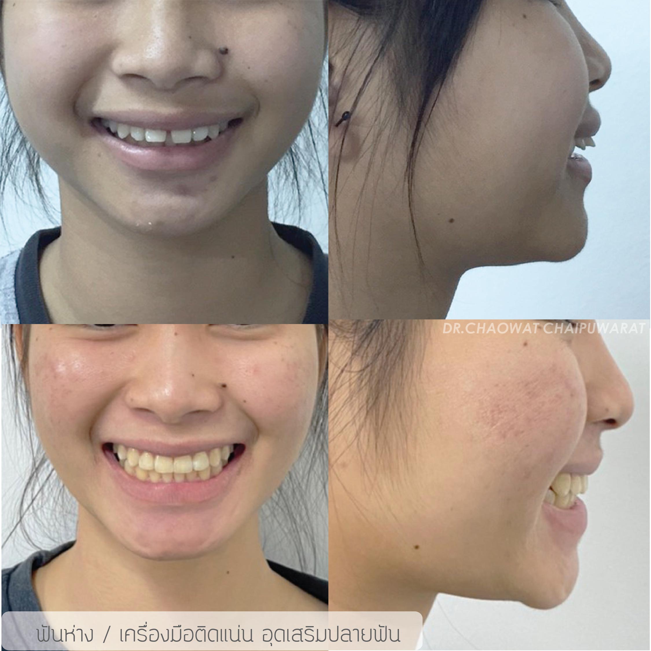 จัดฟันโลหะ