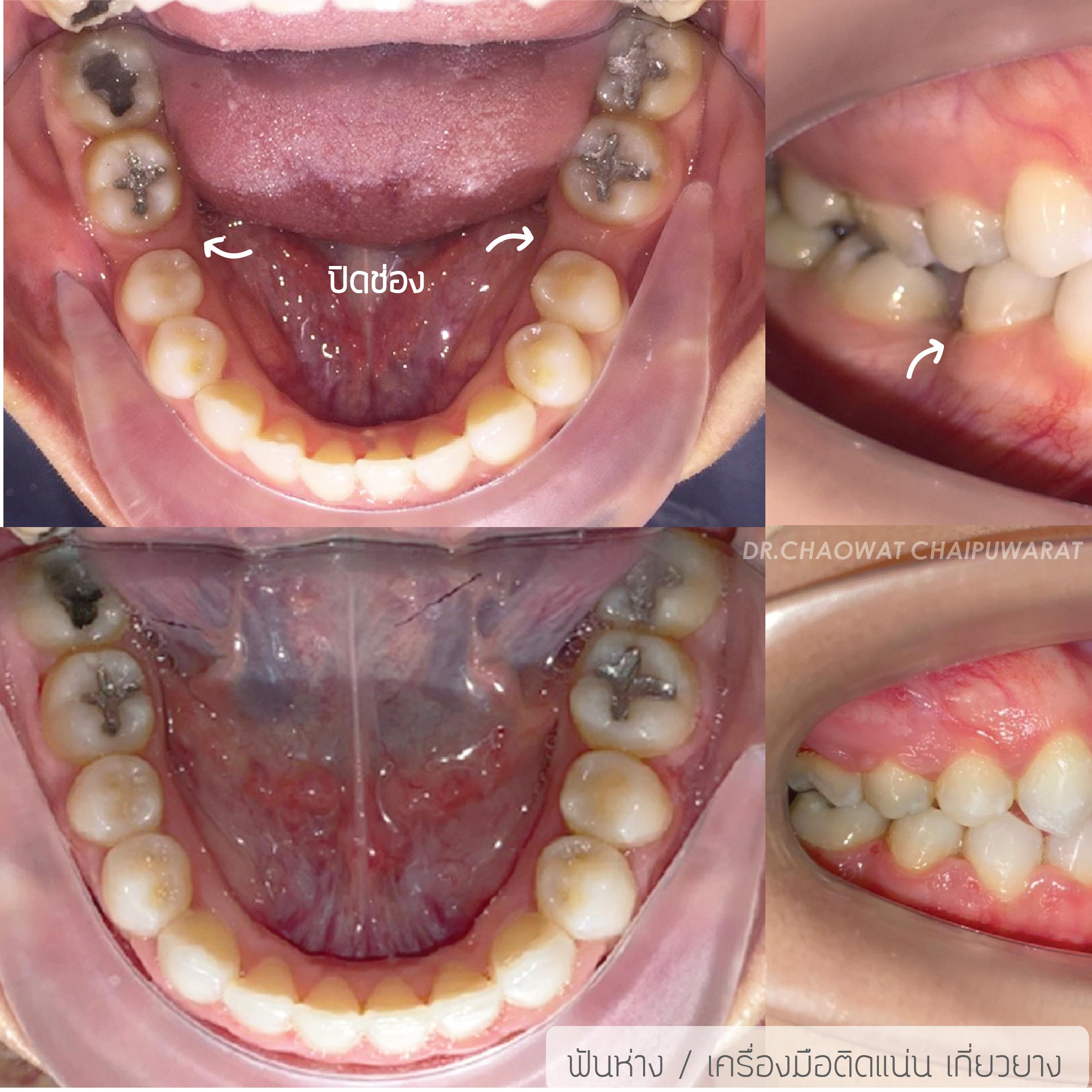 จัดฟันโลหะ
