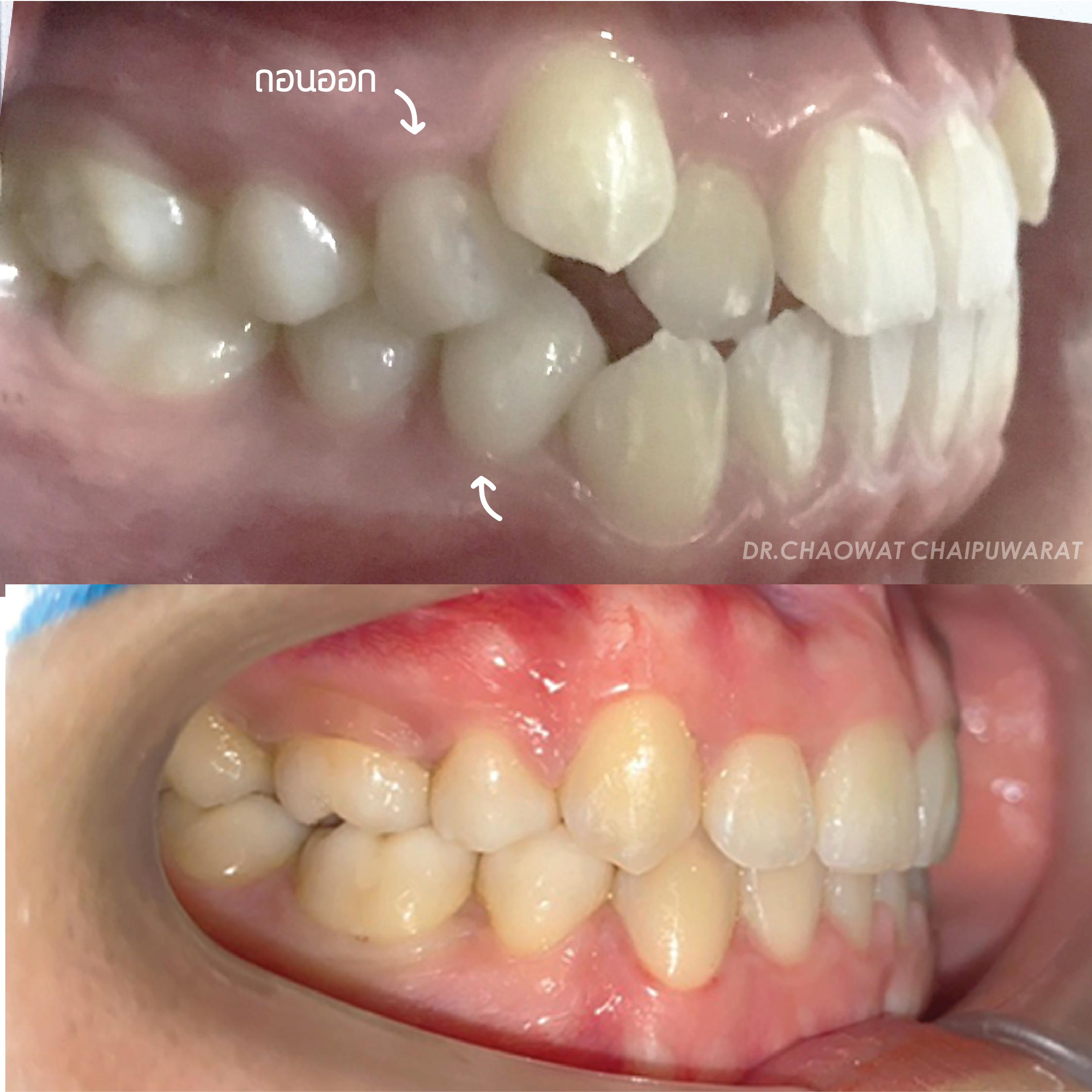 จัดฟันโลหะ