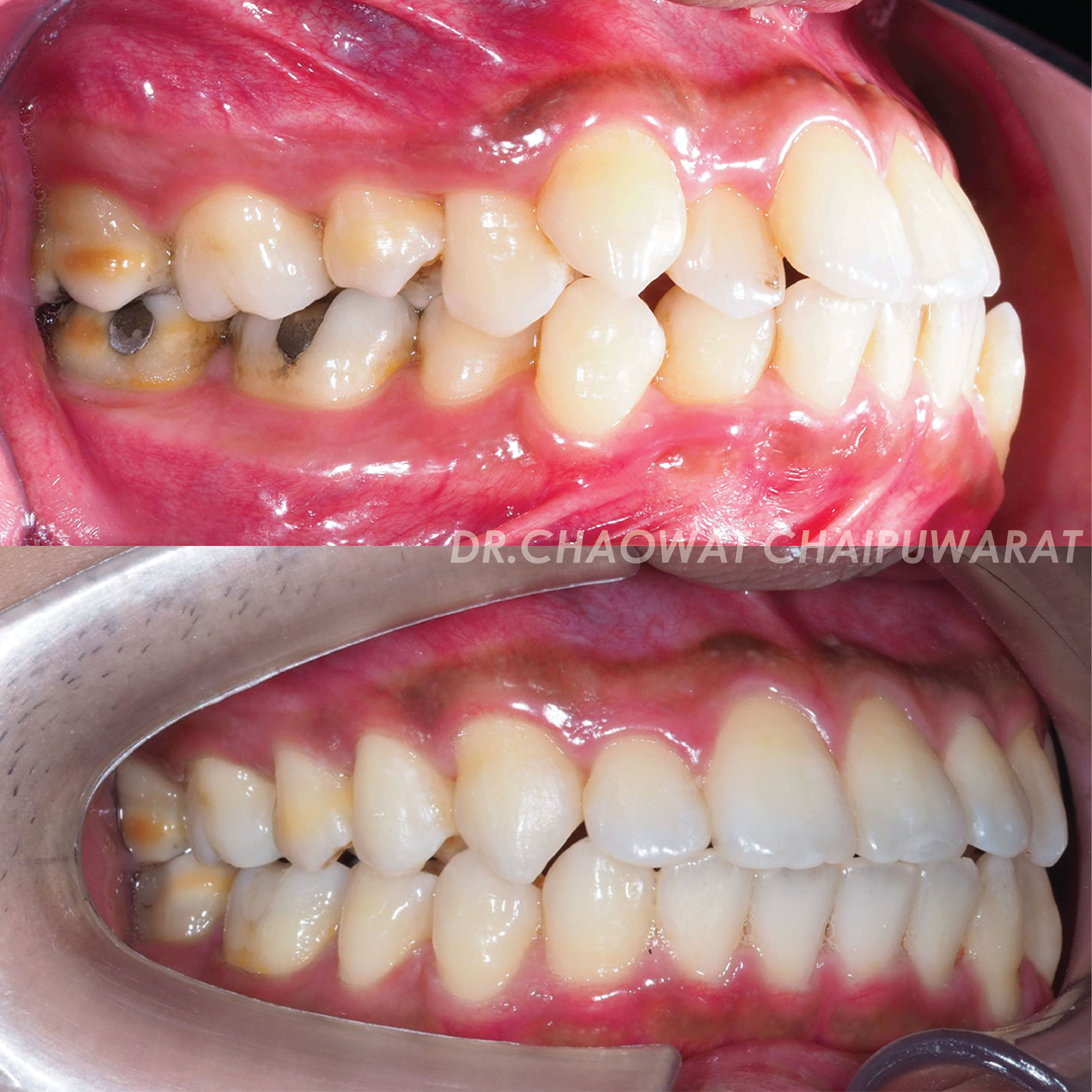 จัดฟันโลหะ