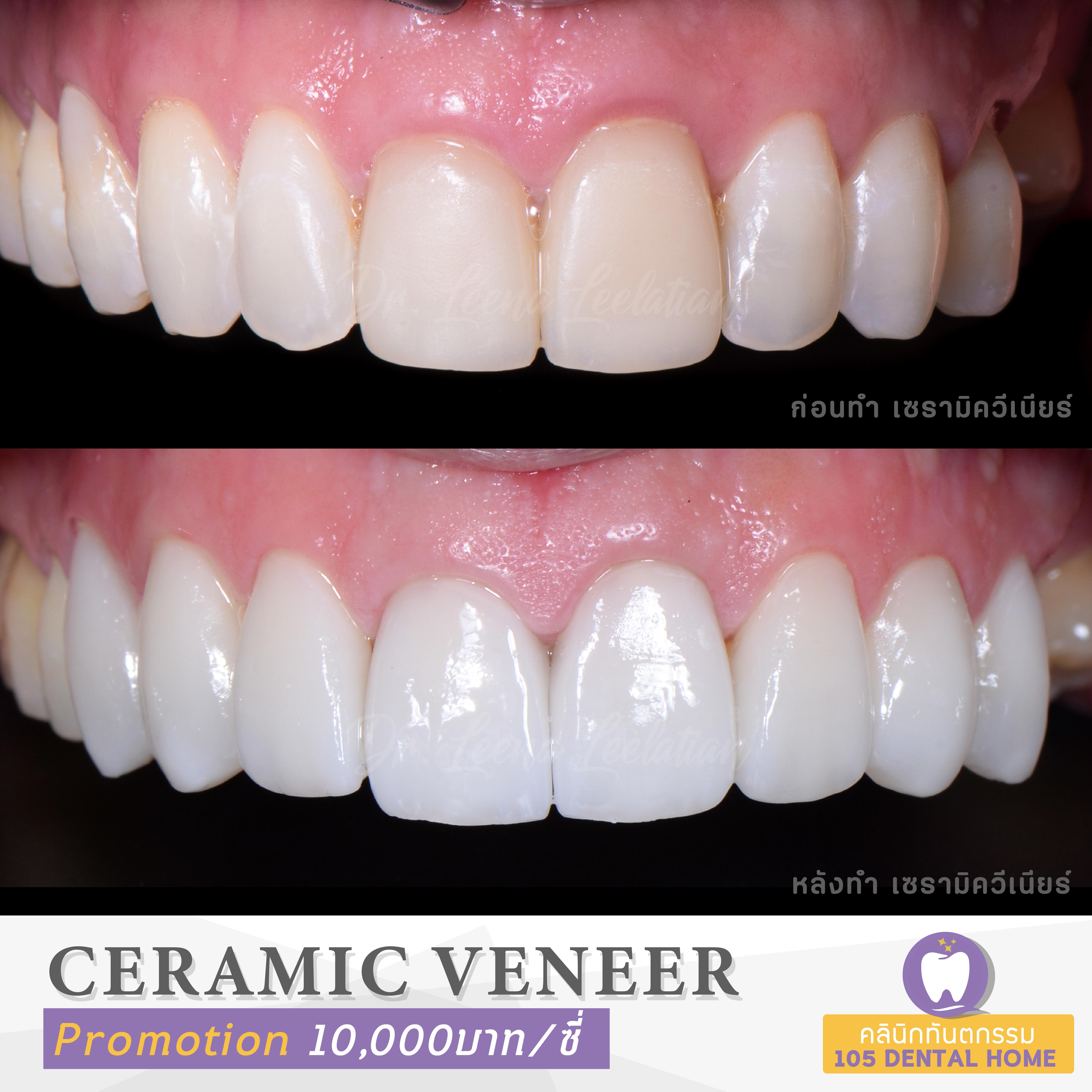 โปรโมชัน Ceramic Veneer