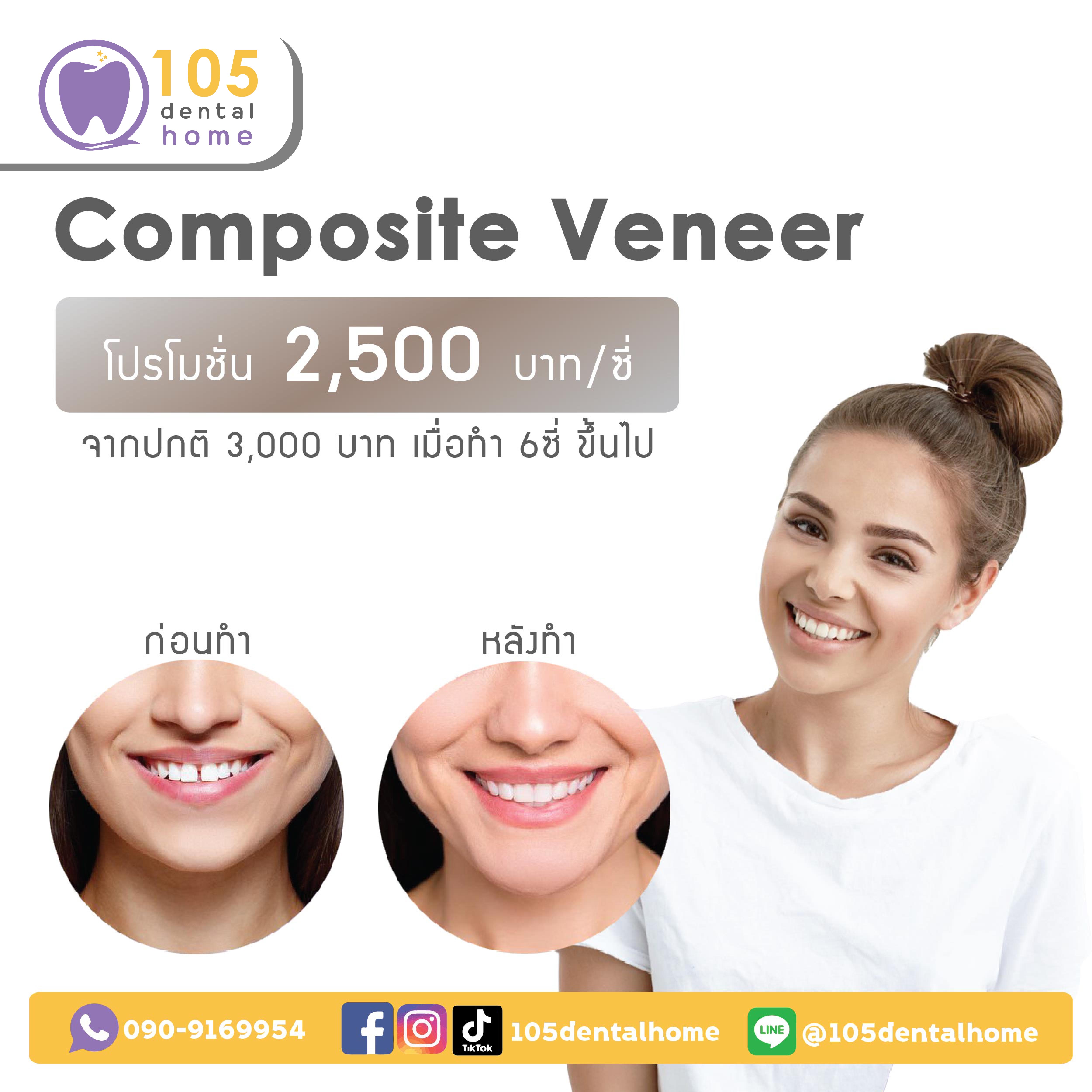 โปรโมชัน คอมโพสิต วีเนียร์