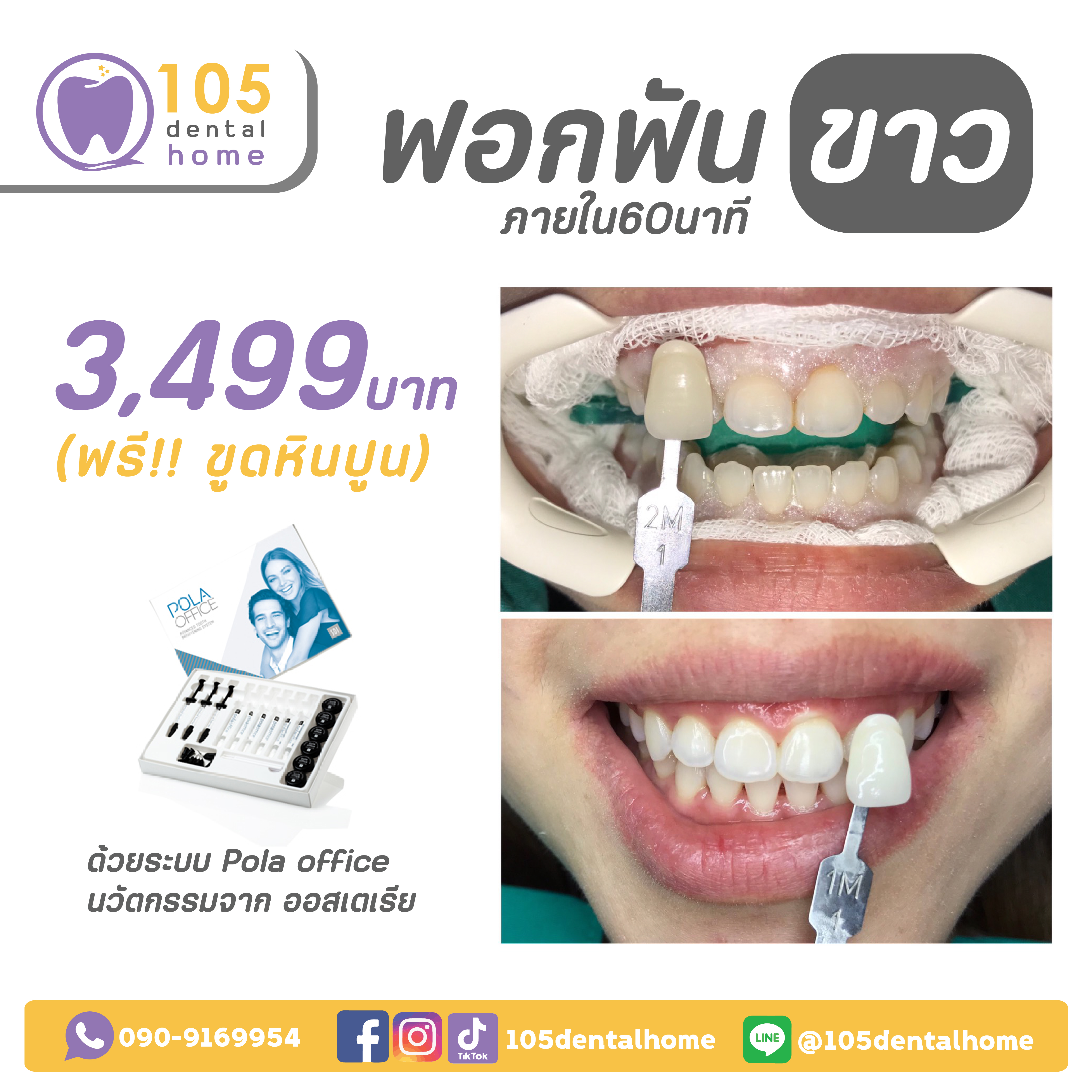 โปรโมชัน ฟอกฟันขาว
