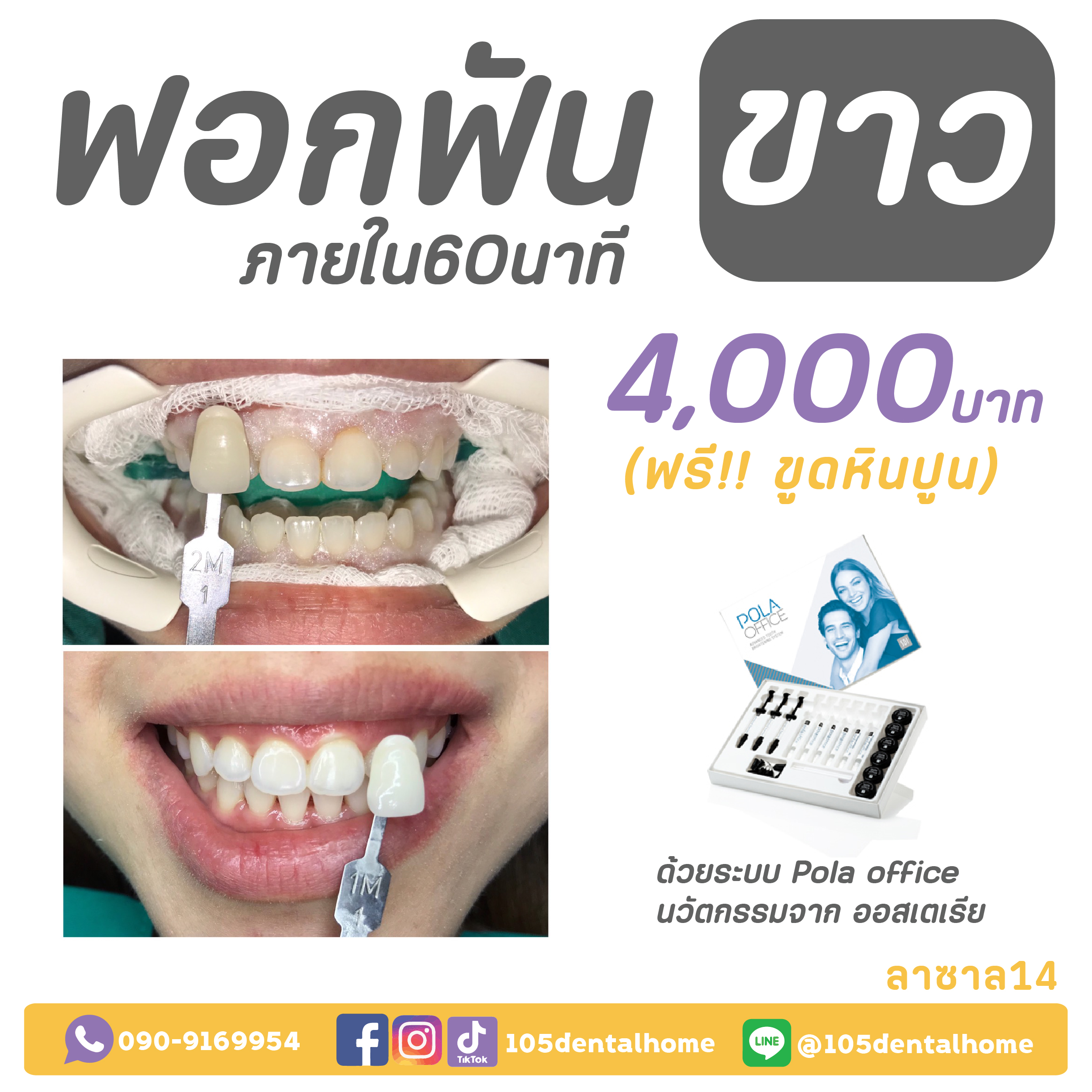 โปรโมชัน ฟอกฟันขาว